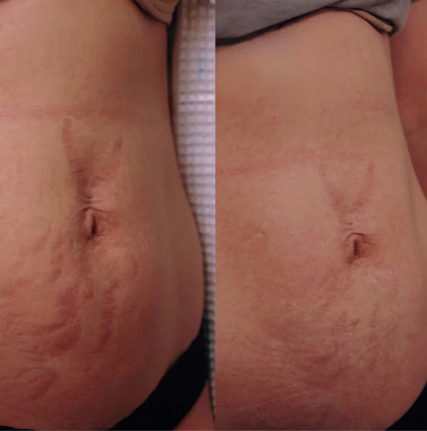 Ultra - THERMALIGHT BELT